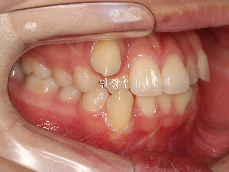 인비절라인 덧니 치료 전 상태