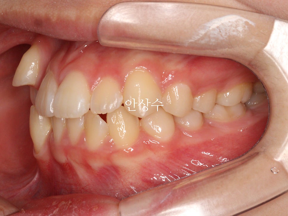 인비절라인 덧니 치료 전 상태