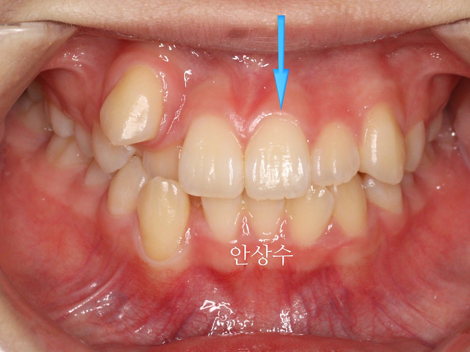 인비절라인 덧니 치료 전 상태