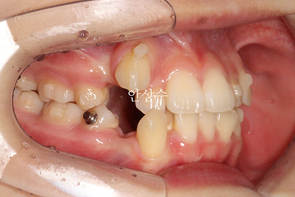인비절라인 덧니 치료 전 상태