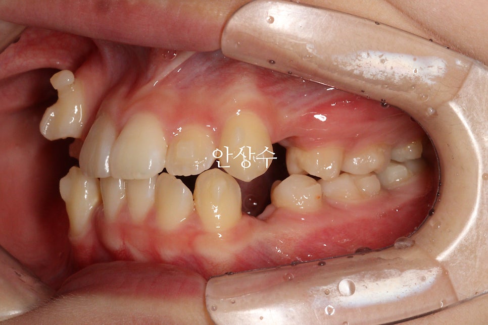 인비절라인 발치 교정 진행