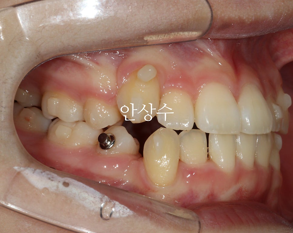 인비절라인 발치 교정 진행