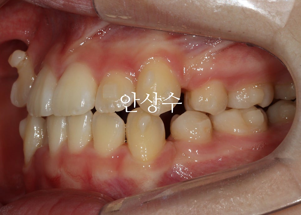 인비절라인 발치 교정 진행