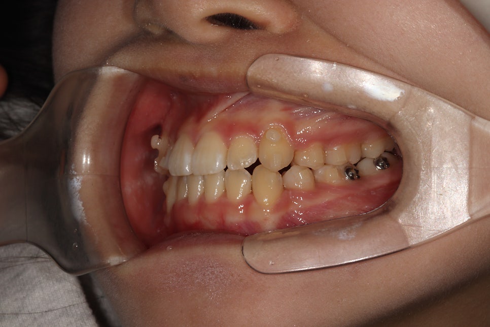 인비절라인 덧니 교정 6개월 경과