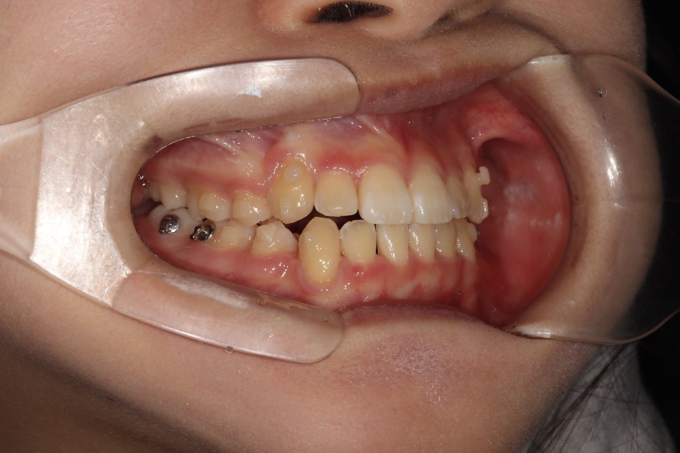 인비절라인 덧니 교정 6개월 경과