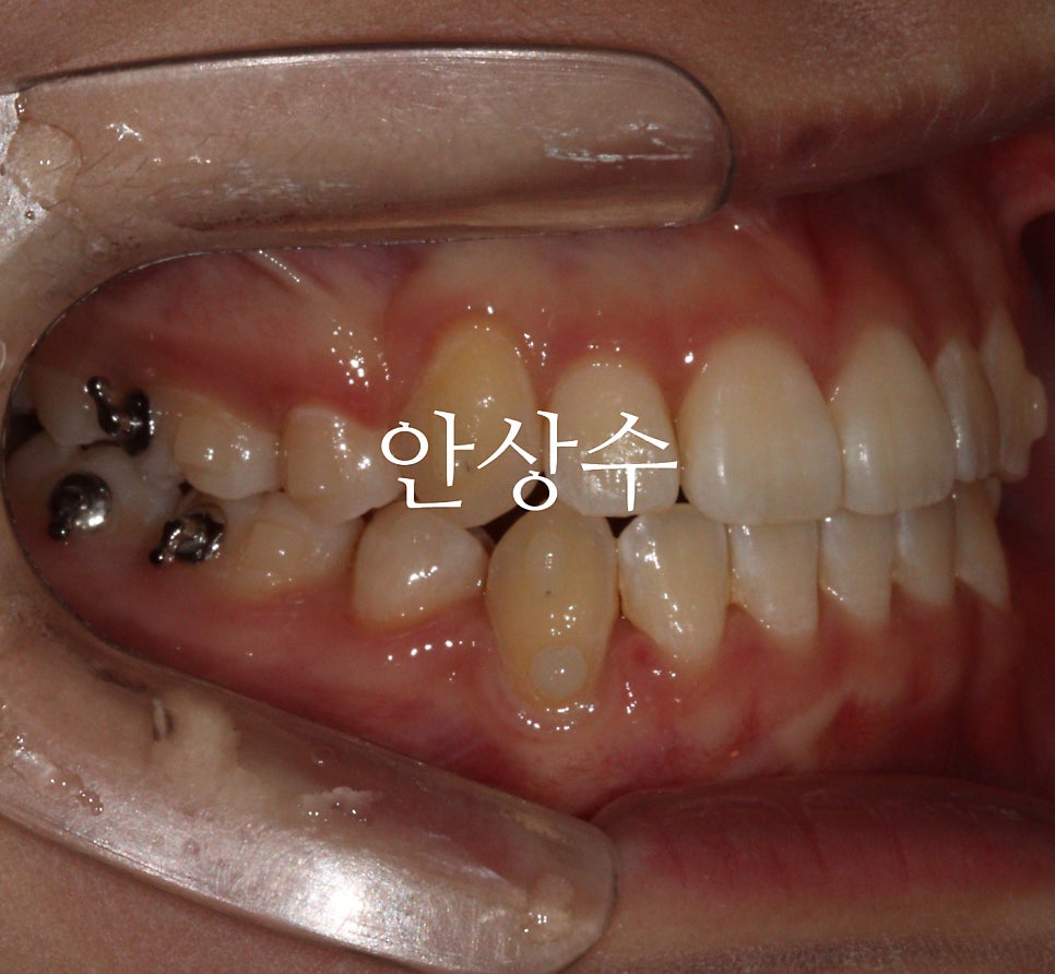 인비절라인 덧니 교정 6개월 경과