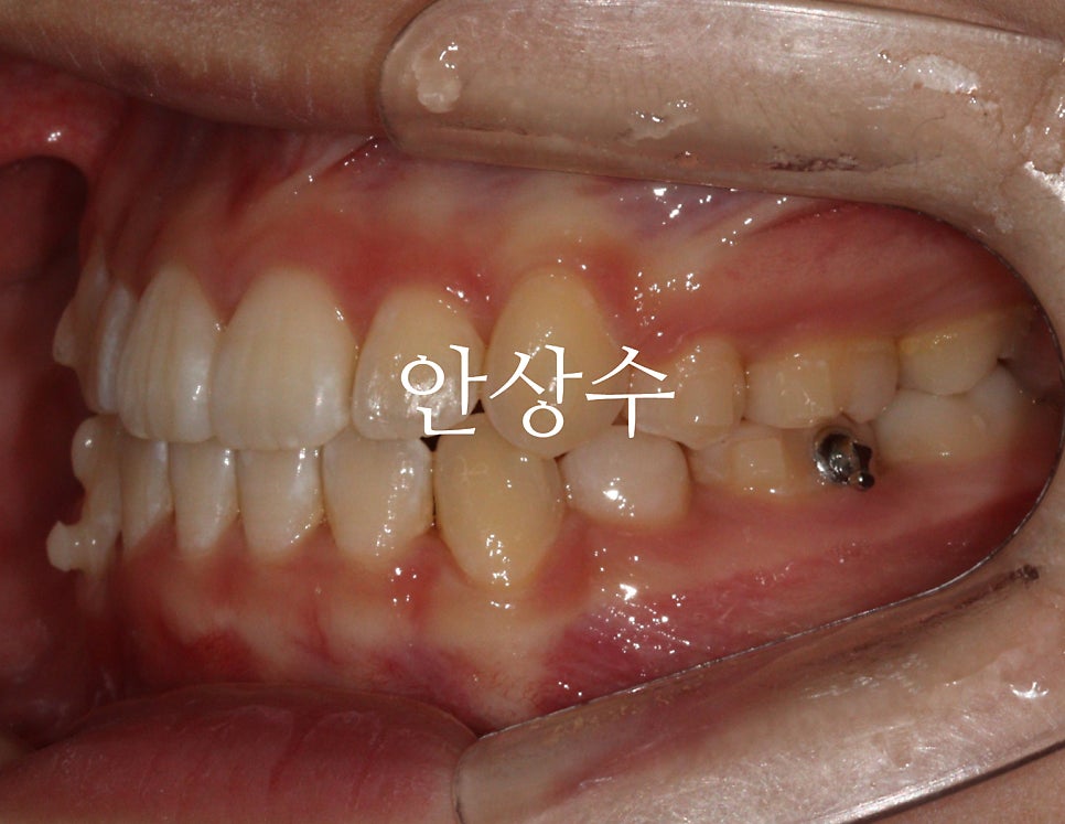 인비절라인 첫 세트 종료 후 모습