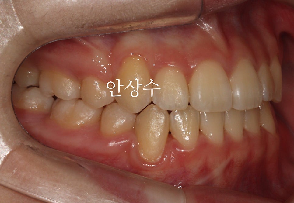 인비절라인 첫 세트 종료 후 모습