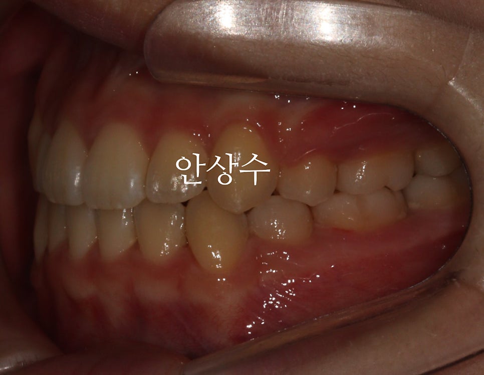 인비절라인 첫 세트 종료 후 모습
