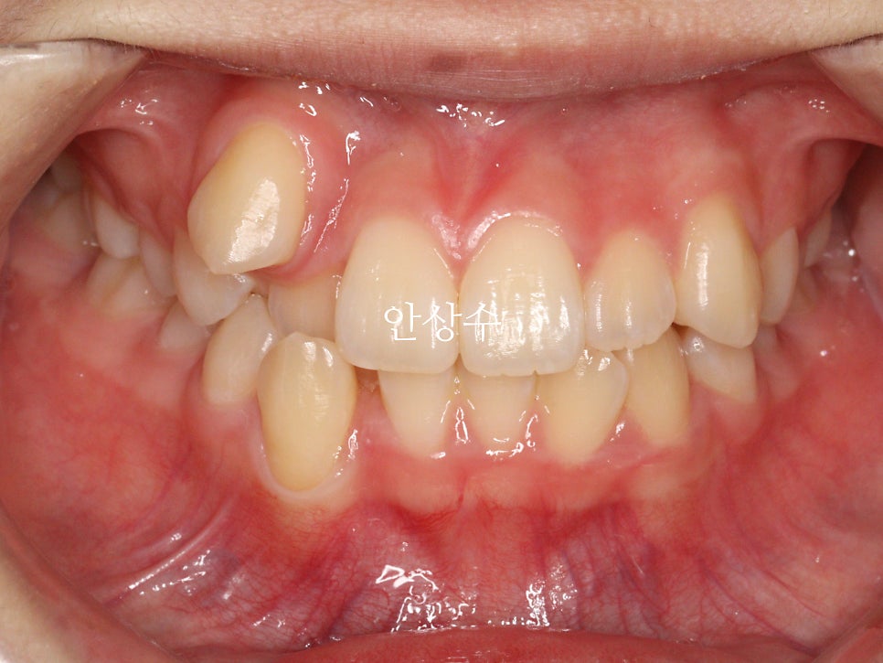 인비절라인 덧니 발치 교정 전후 비교