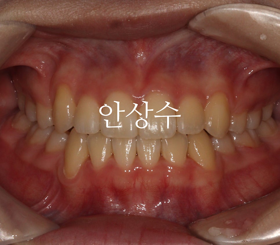 인비절라인 덧니 발치 교정 전후 비교