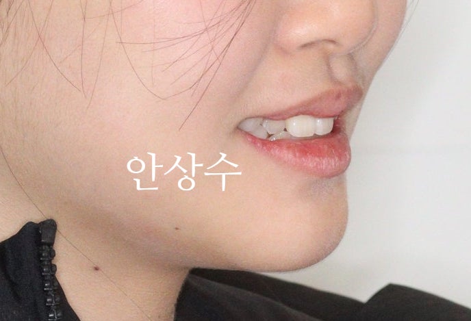 인비절라인 덧니 발치 교정 전후 비교