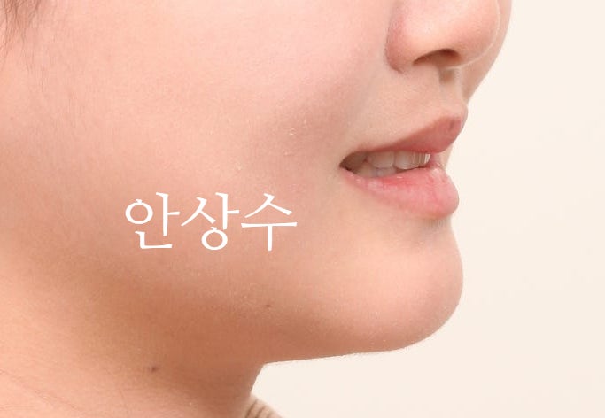 인비절라인 덧니 발치 교정 전후 비교