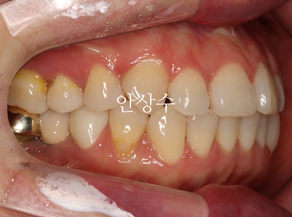 인비절라인 발치 교정 치료 전 구강 상태