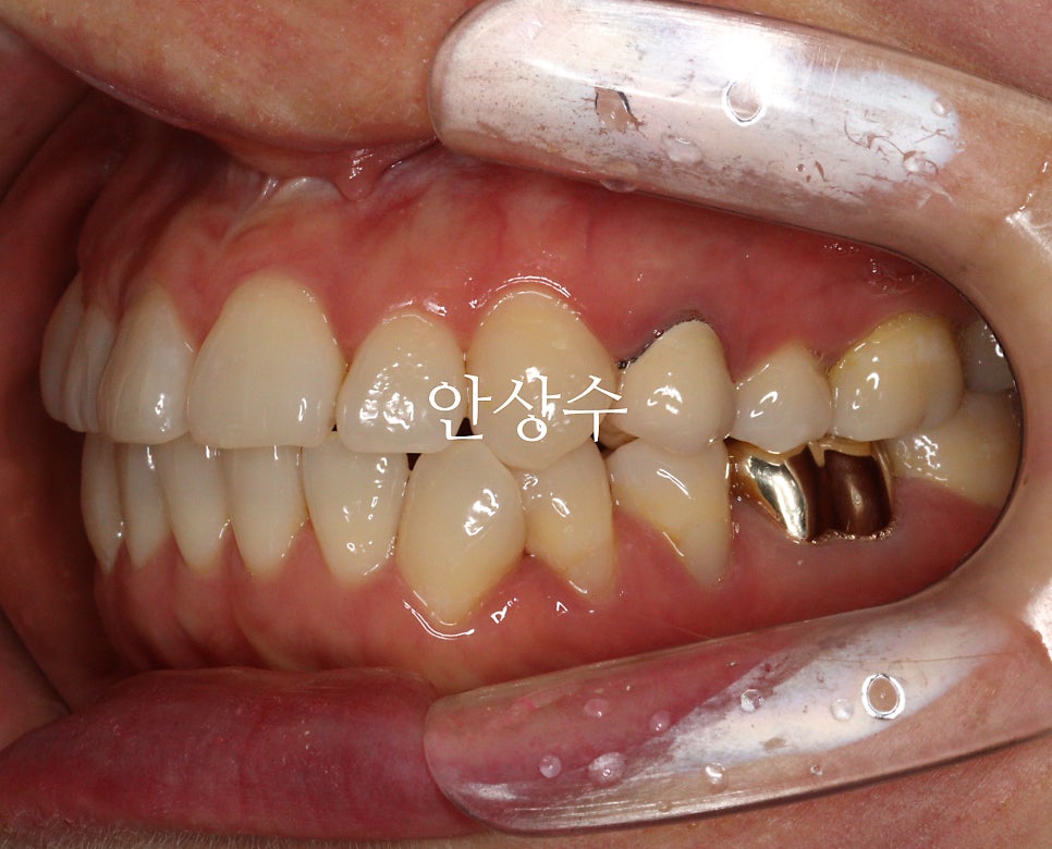 인비절라인 발치 교정 치료 전 구강 상태