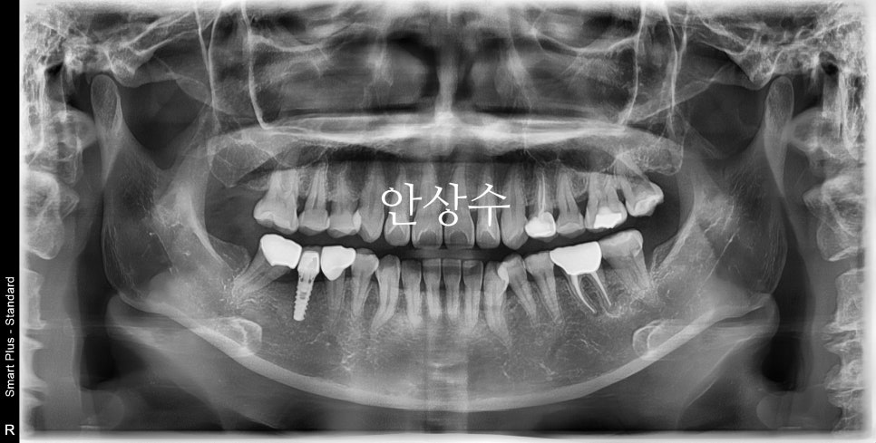 인비절라인 발치 교정 치료 전 구강 상태