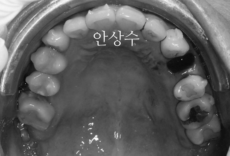 인비절라인 발치 교정 치료 전 구강 상태