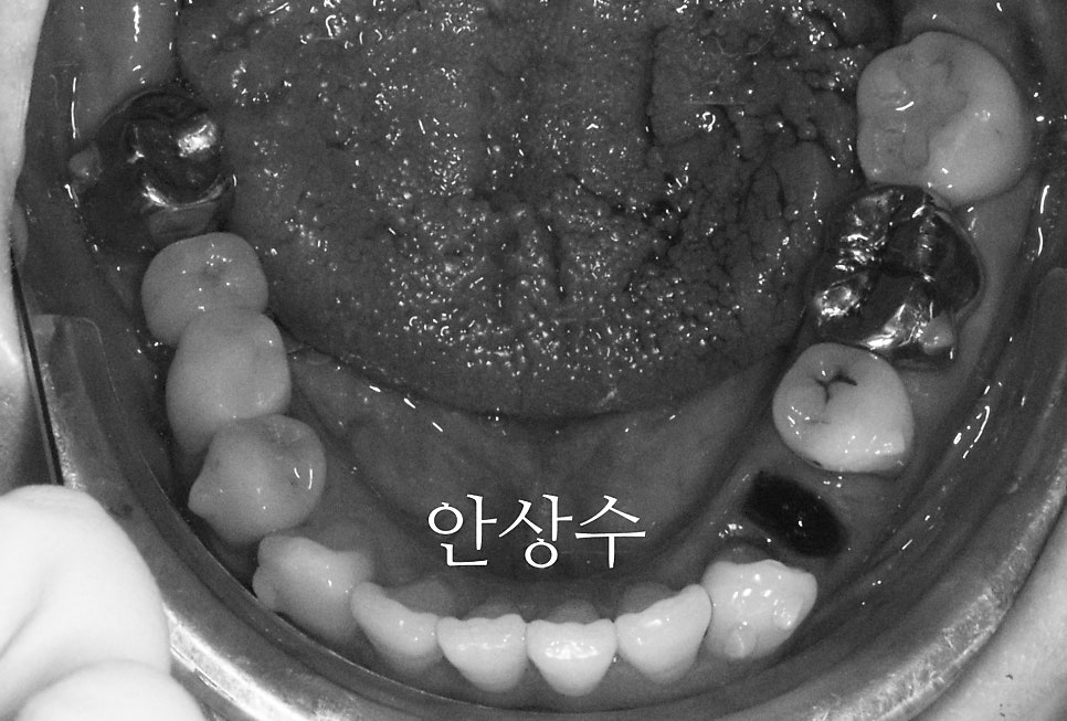 비대칭 발치 계획