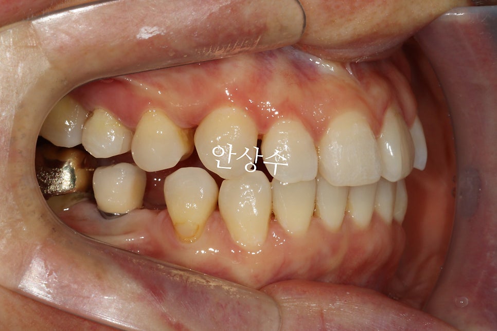 비대칭 발치 계획