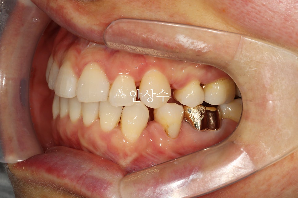 비대칭 발치 계획