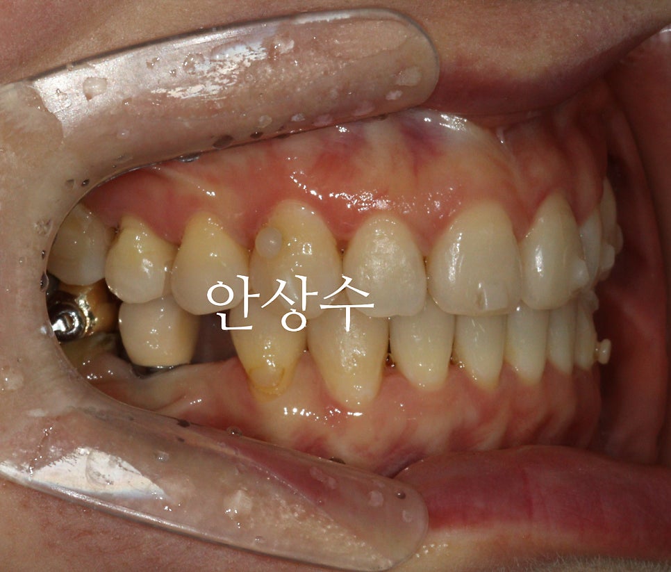 인비절라인 치료 중간 경과