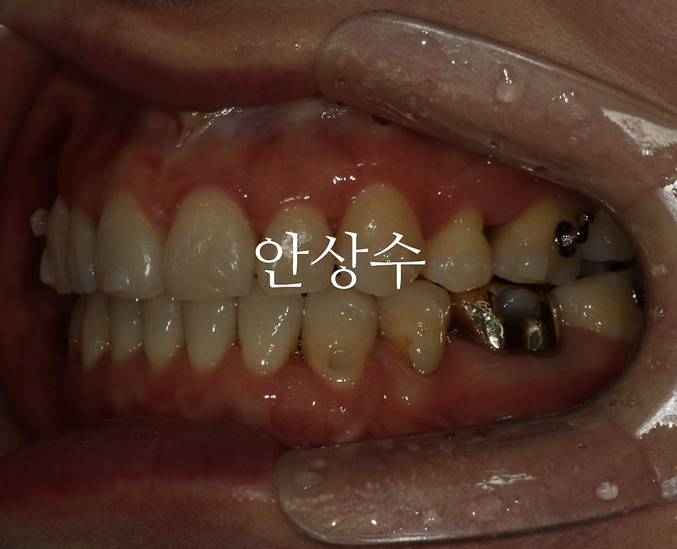 인비절라인 치료 중간 경과