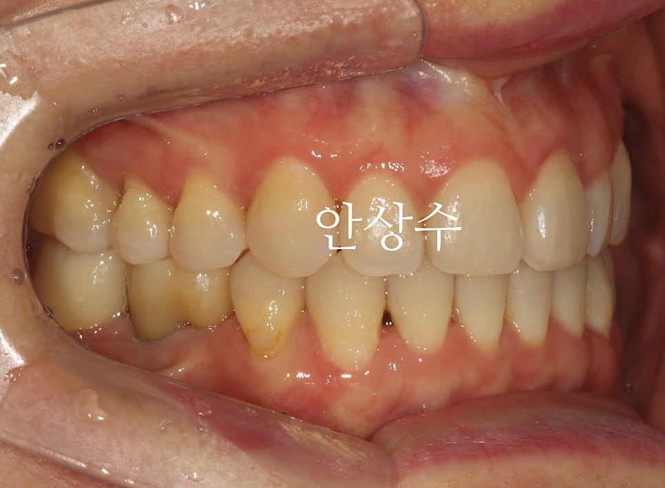 인비절라인 재제작 후 경과