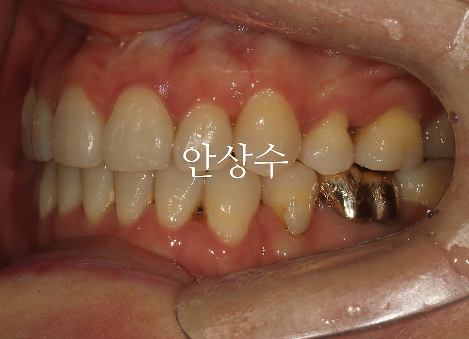 인비절라인 재제작 후 경과