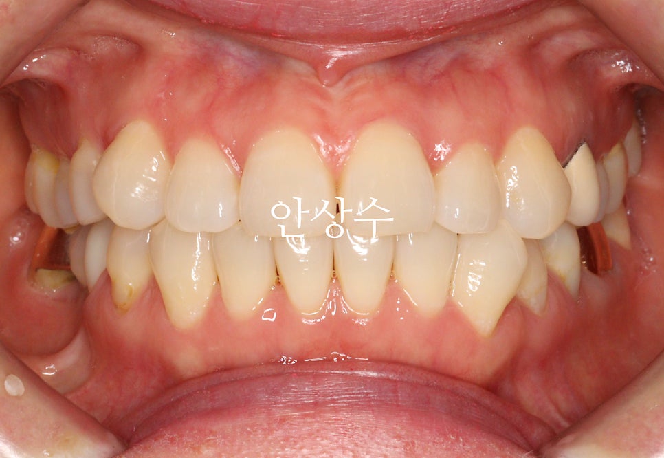 인비절라인 발치 교정 치료 후 결과