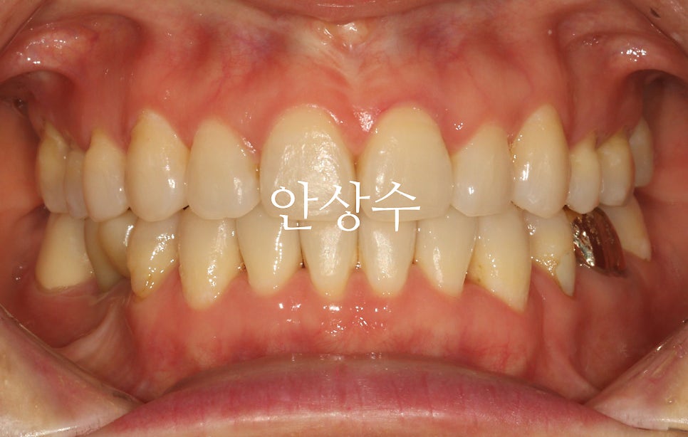 인비절라인 발치 교정 치료 후 결과