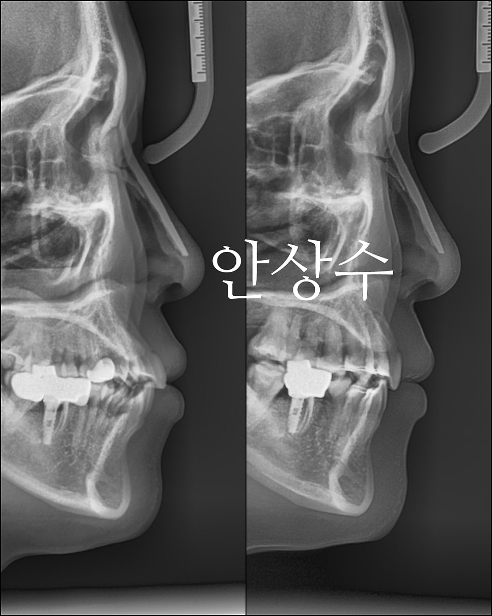 인비절라인 발치 교정 치료 후 결과