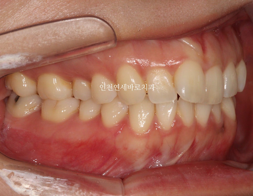 인비절라인 치료를 하면 미니스크류 교정용나사 안 심는다고?