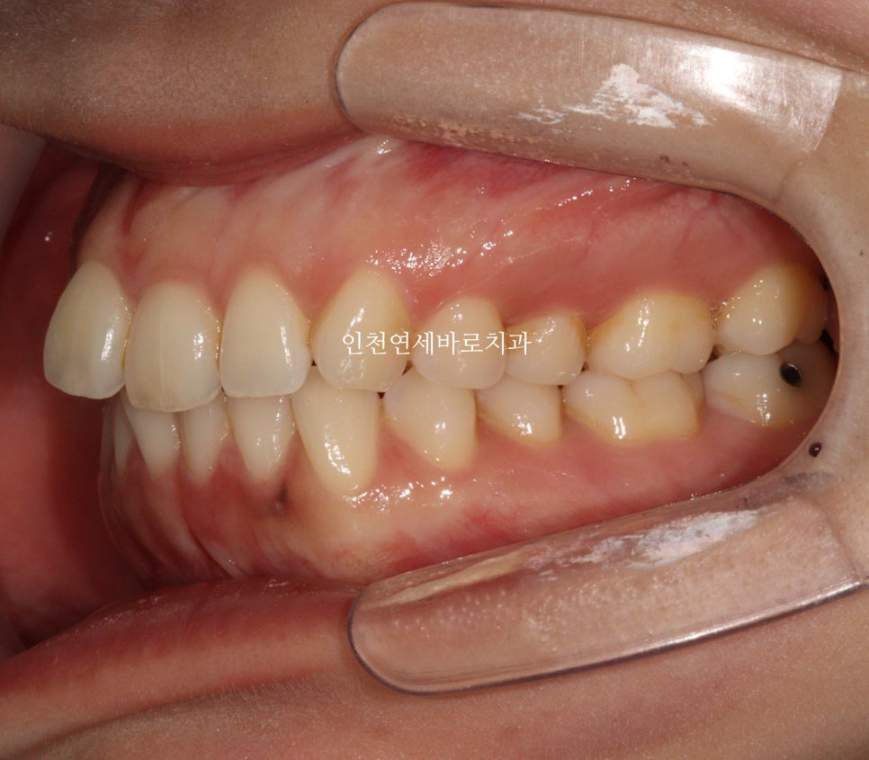 인비절라인 치료를 하면 미니스크류 교정용나사 안 심는다고?