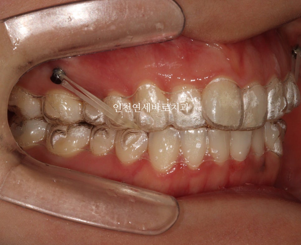 인비절라인 치료를 하면 미니스크류 교정용나사 안 심는다고?