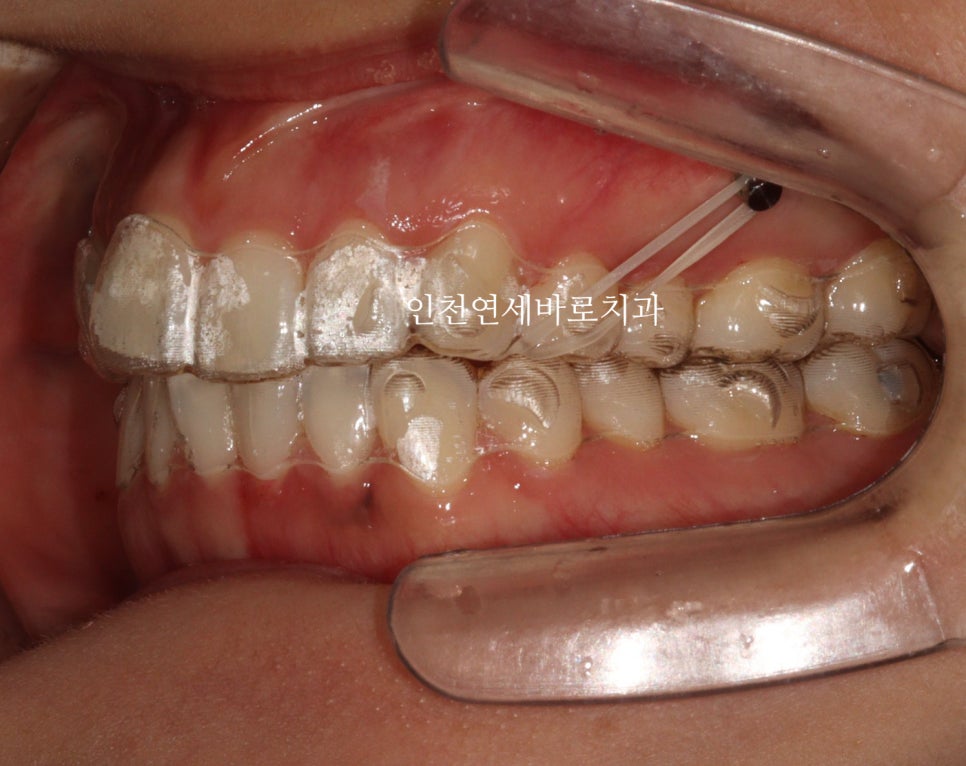 인비절라인 치료를 하면 미니스크류 교정용나사 안 심는다고?