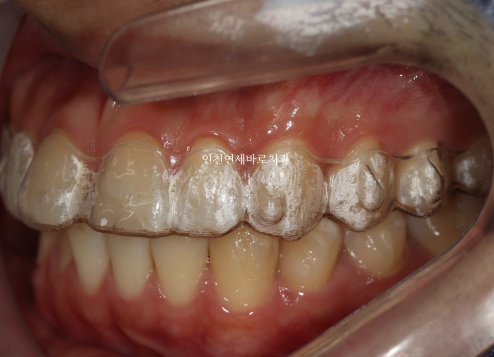 인비절라인 치료를 하면 미니스크류 교정용나사 안 심는다고?