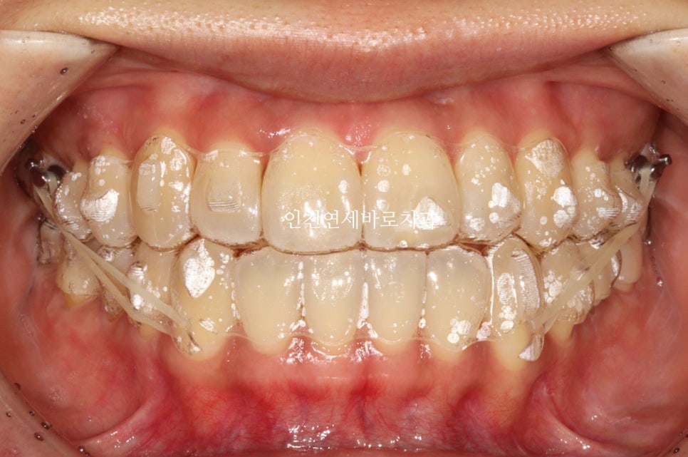 인비절라인 등급에서 알아두어야 할 점