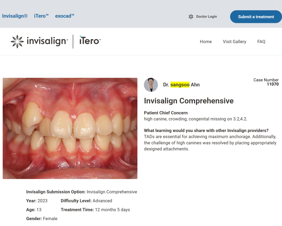 돌출입 교정치료, 인비절라인 장치로도 가능한 이유