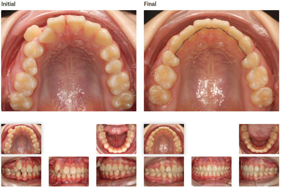 돌출입 교정치료, 인비절라인 장치로도 가능한 이유