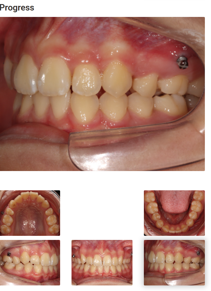 돌출입 교정치료, 인비절라인 장치로도 가능한 이유