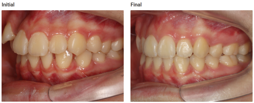 돌출입 교정치료, 인비절라인 장치로도 가능한 이유