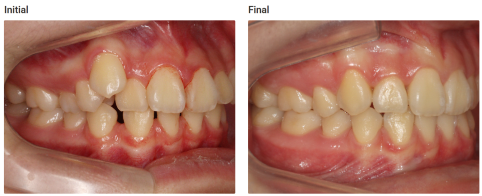 돌출입 교정치료, 인비절라인 장치로도 가능한 이유