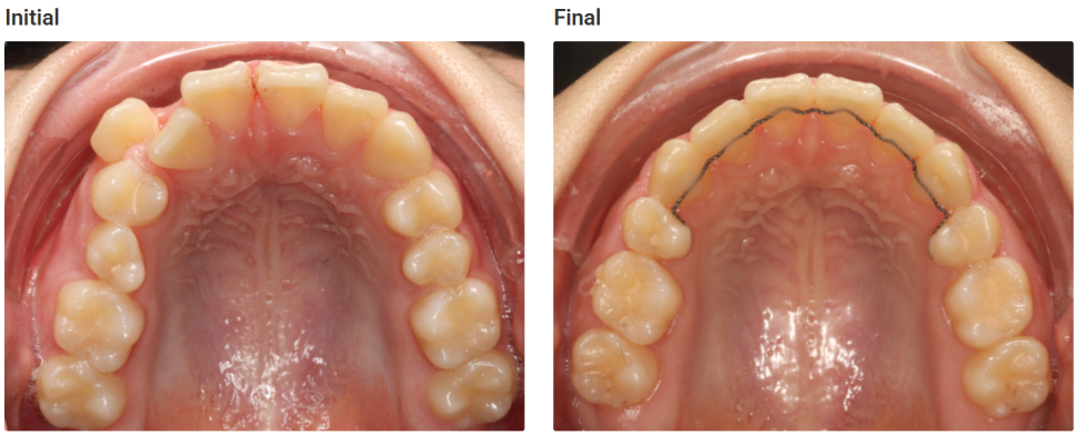 돌출입 교정치료, 인비절라인 장치로도 가능한 이유