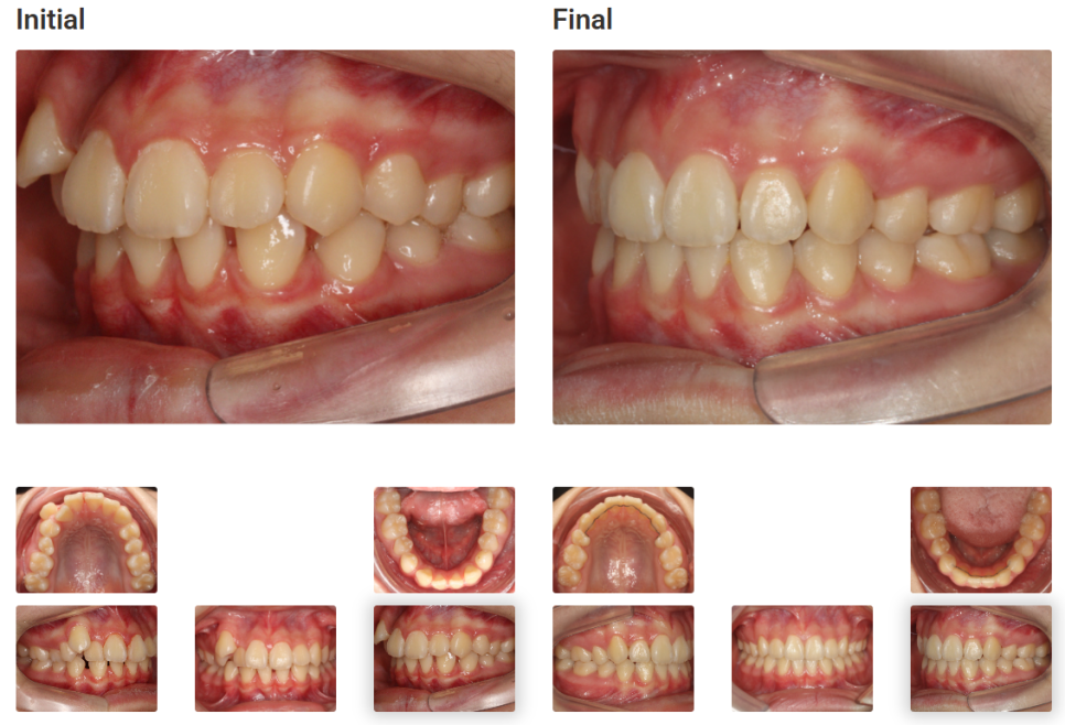 돌출입 교정치료, 인비절라인 장치로도 가능한 이유