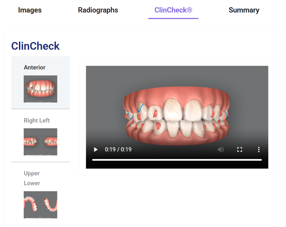 돌출입 교정치료, 인비절라인 장치로도 가능한 이유