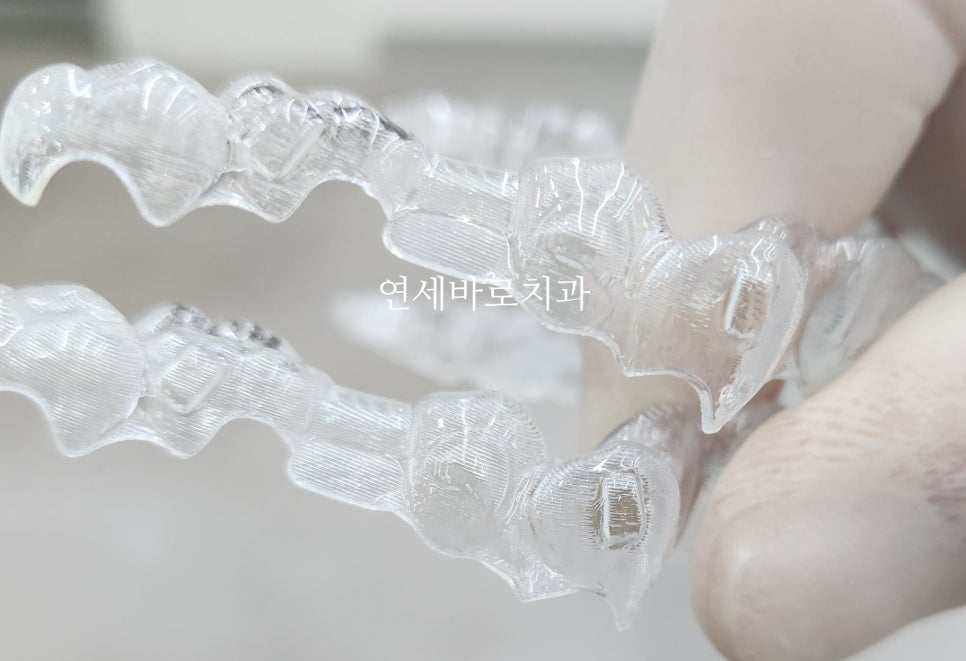 돌출입 교정치료, 인비절라인 장치로도 가능한 이유