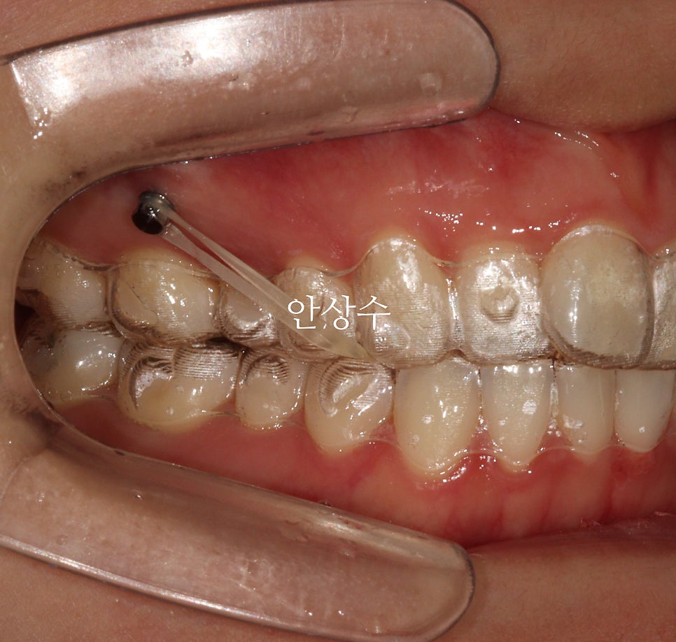 인비절라인 강연자가 알려주는 인비절라인 상식 몇가지 인천인비절라인 알아보시는 분들 필독입니다.
