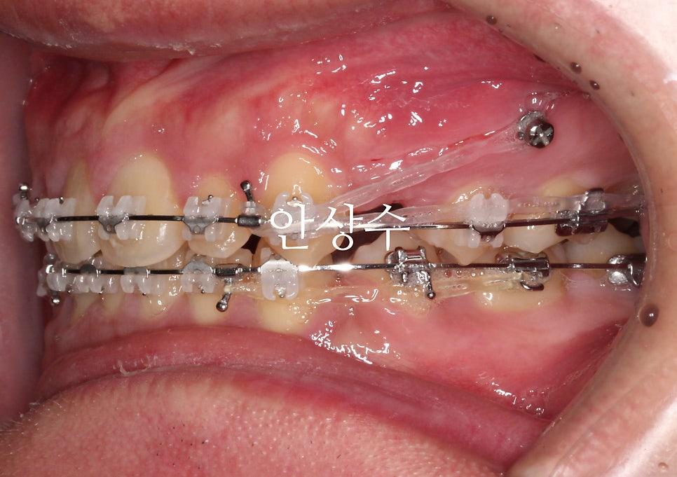 인비절라인 강연자가 알려주는 인비절라인 상식 몇가지 인천인비절라인 알아보시는 분들 필독입니다.