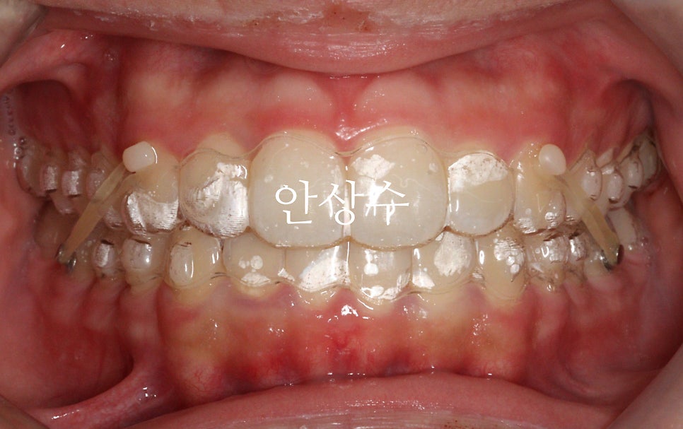 인비절라인 강연자가 알려주는 인비절라인 상식 몇가지 인천인비절라인 알아보시는 분들 필독입니다.