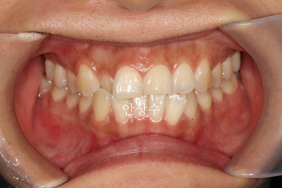 인비절라인 라이트, 철사교정과 비슷한 가격으로 인비절라인 치료하는 방법